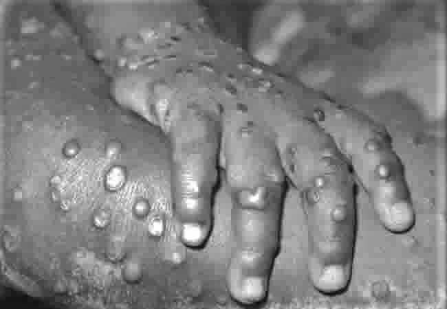 WHO declares mpox global health emergency