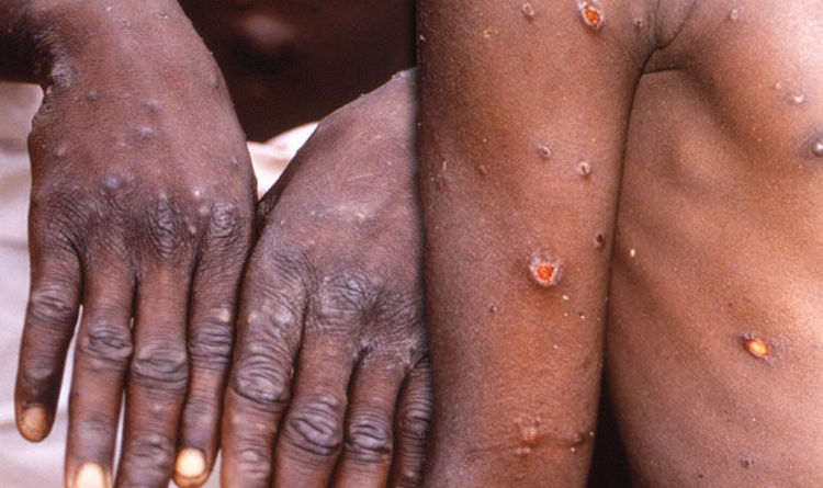 GHS confirms Monkeypox case, 230 suspected cases across 88 districts