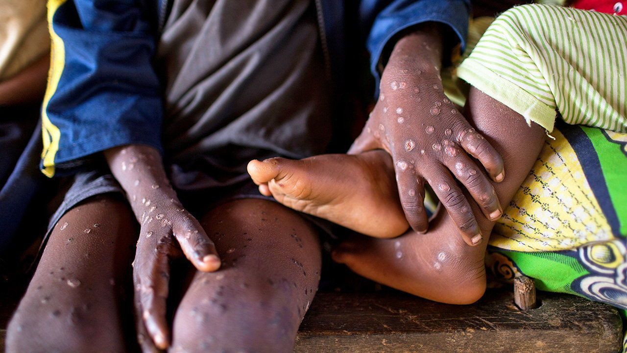 Mpox: New death recorded as GHS raises fresh concerns