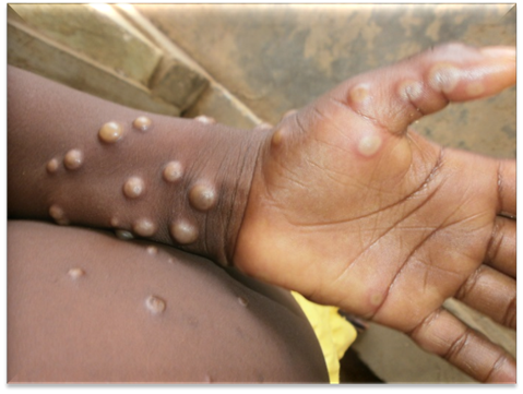 Mpox cases surge to 409
