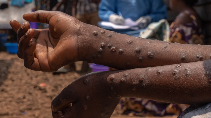 Mpox cases surge to 467