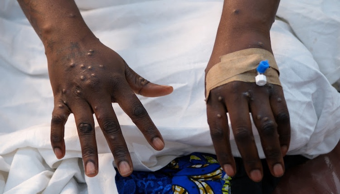 Ghana Health Service confirms 3 new fatalities from Mpox