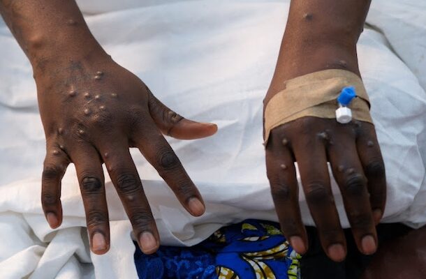 Ghana records 16 new Mpox cases as total infections near 900 Ghana records 16 new Mpox cases as total infections near 900