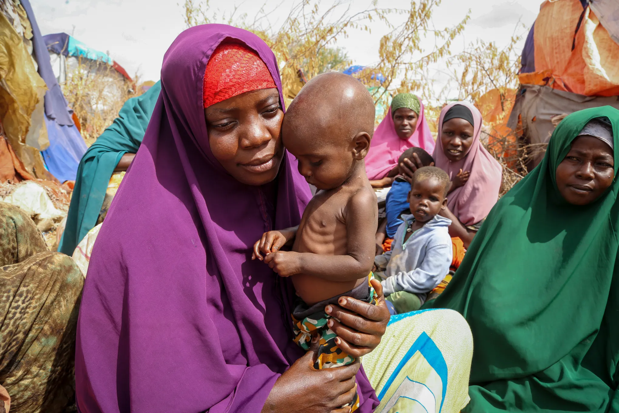 Somalia malnutrition funding drops 80% as child hunger surges Somalia malnutrition funding drops 80% as child hunger surges